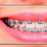BraceMate: Simulador de Aparatos Dentales